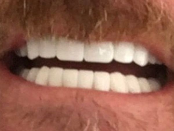 Smileinturkey full teeth & trip package