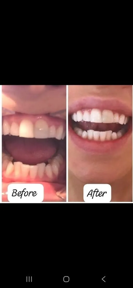 Teeth whitening in comfort of your own home - Image 3