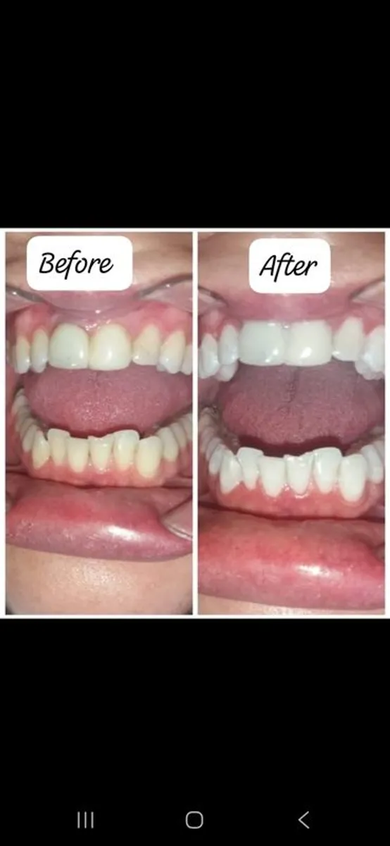Teeth whitening in comfort of your own home - Image 4