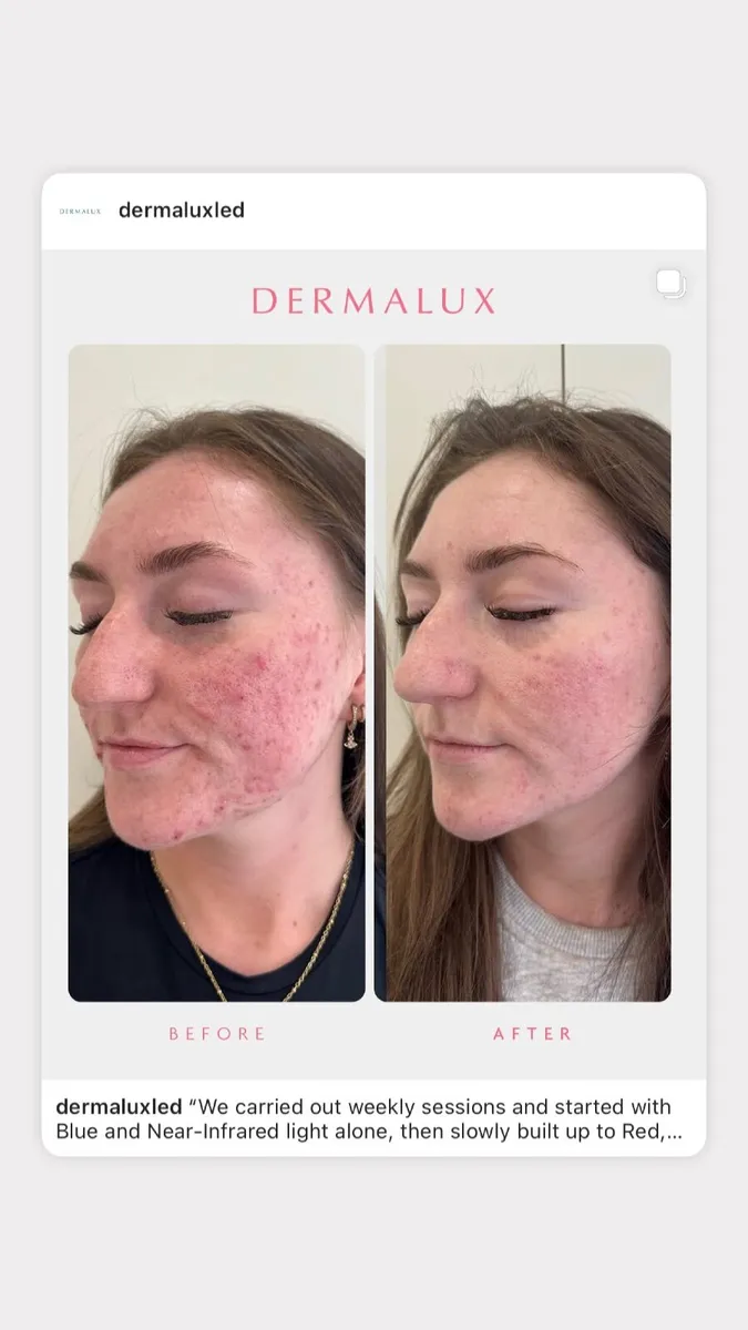 Tri-Wave MD DERMALUX - Image 3