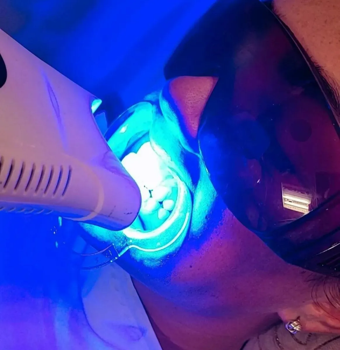 Professional Laser Teeth Whitening System - Image 1