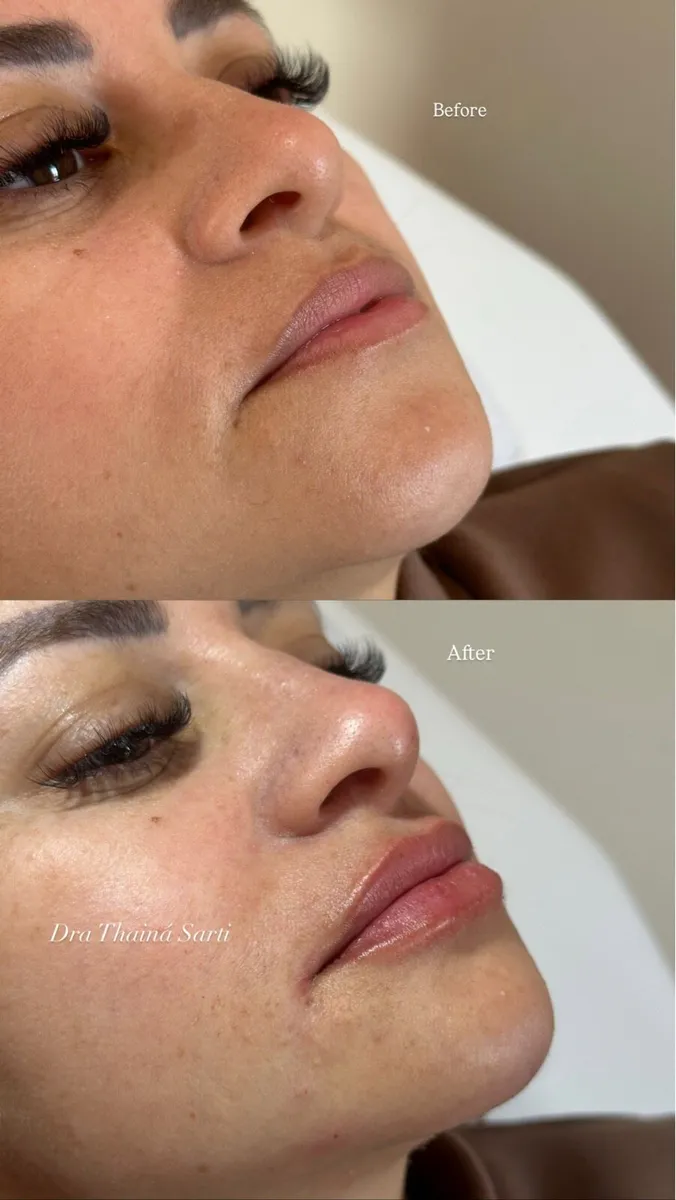 Facial harmonization - Image 1