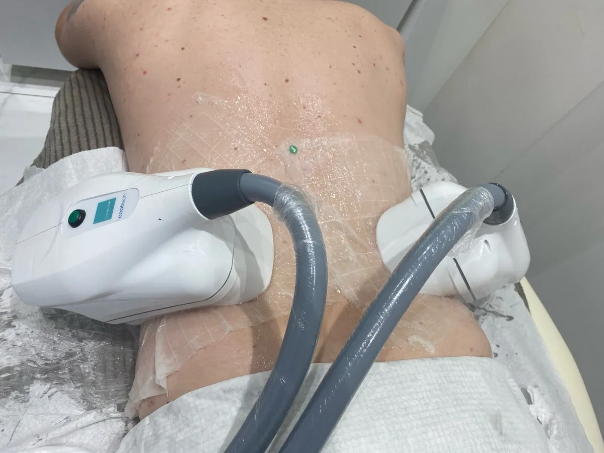 Cryolipolysis machine - Image 4